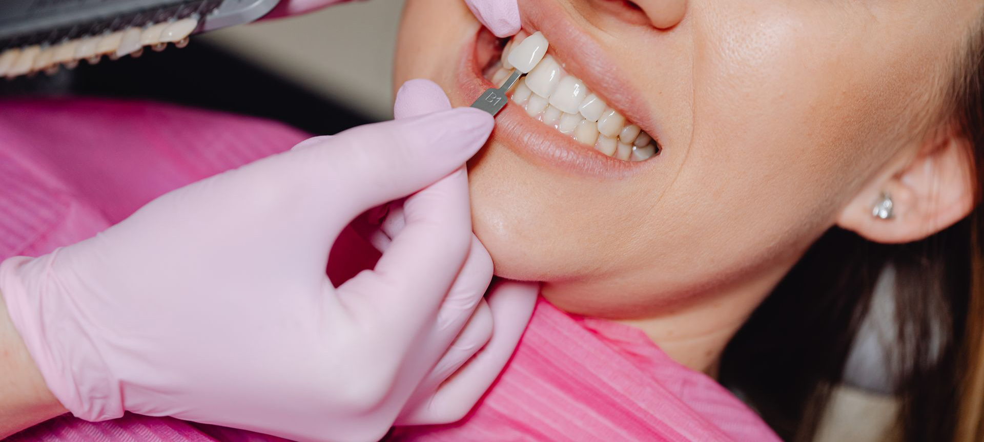 En este momento estás viendo Carillas dentales: qué son y para quién están indicadas