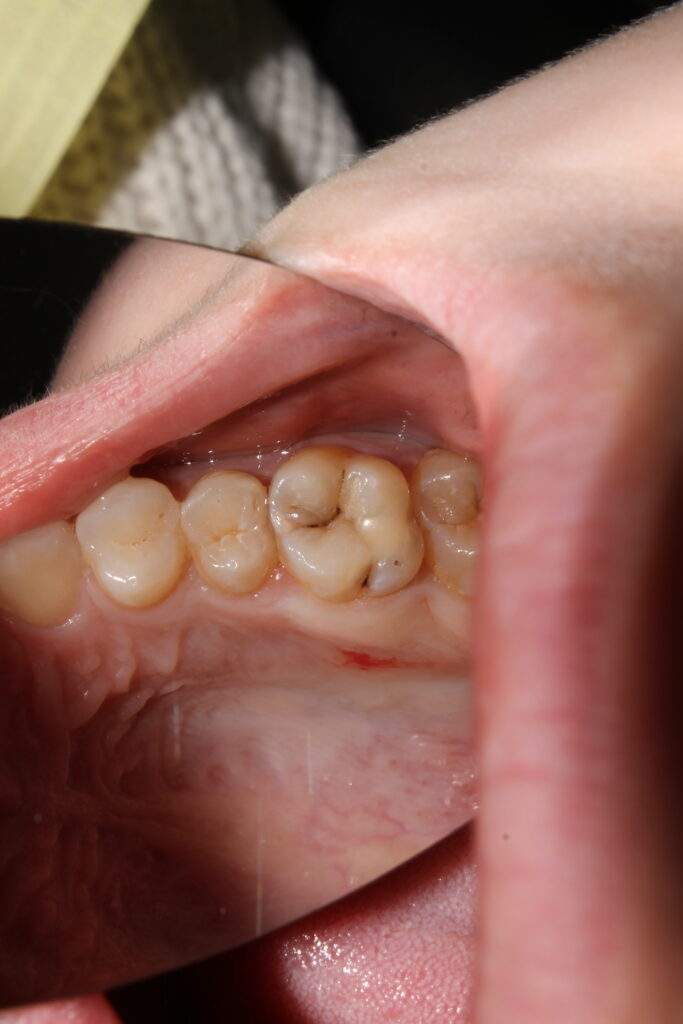 Tratamiento de caries y empastes en Durango